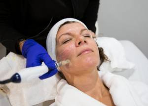 Kelly's bridal skin care recommendations always include one or two microneedling treatments (shown here).